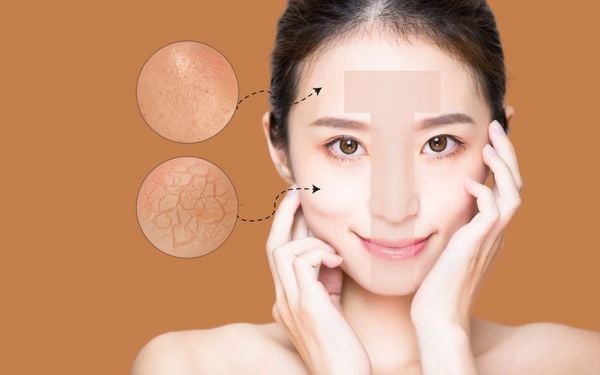 Da dầu, da hỗn hợp có cần dưỡng ẩm